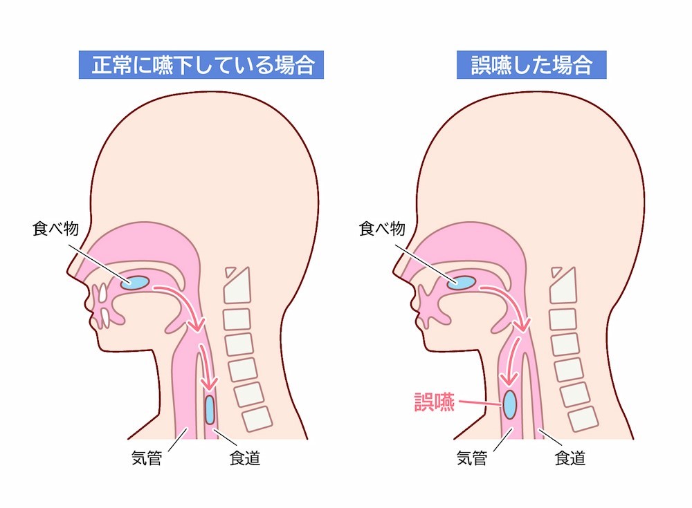 正常な嚥下と誤嚥